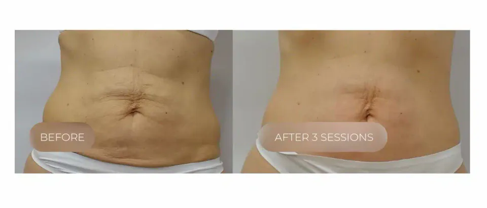 Abdomen before and after 3 sessions of LPG endermologie