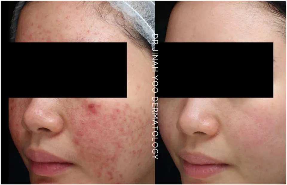 Acne before and after treatment at Dr Jinah Yoo Dermatology