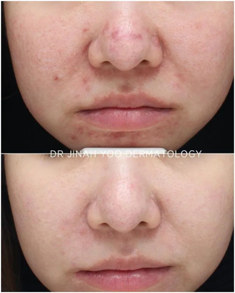 Acne before and after treatment at Dr Jinah Yoo Dermatology