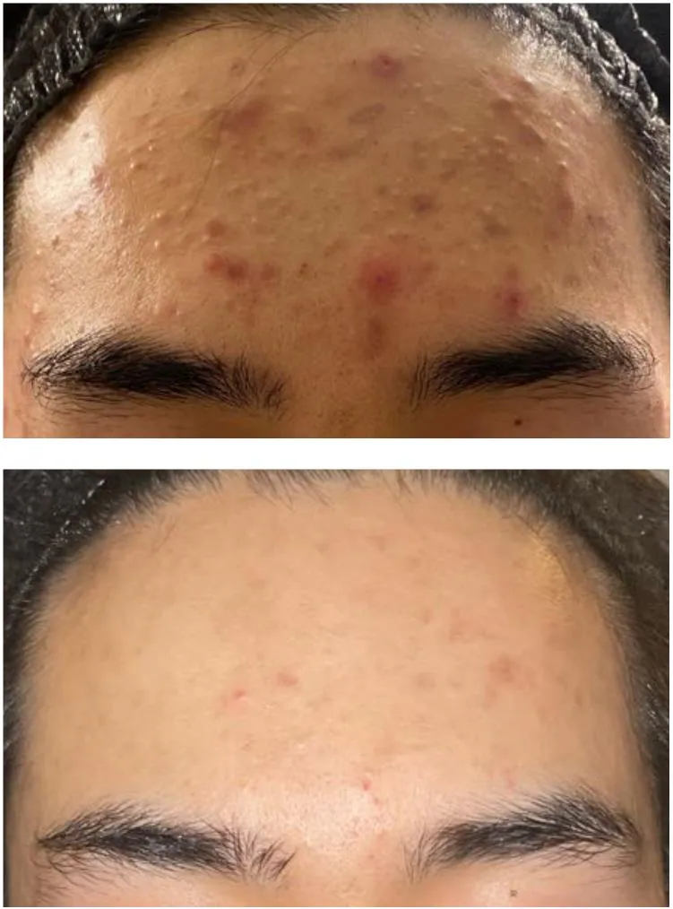 Acne before and after treatment at Dr Jinah Yoo Dermatology