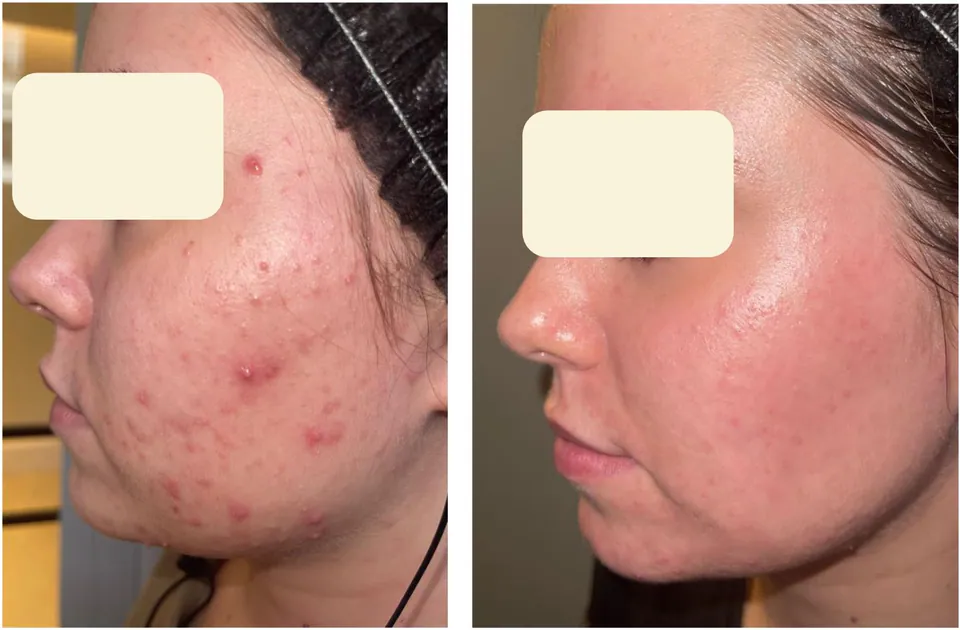 Acne before and after treatment at Dr Jinah Yoo Dermatology