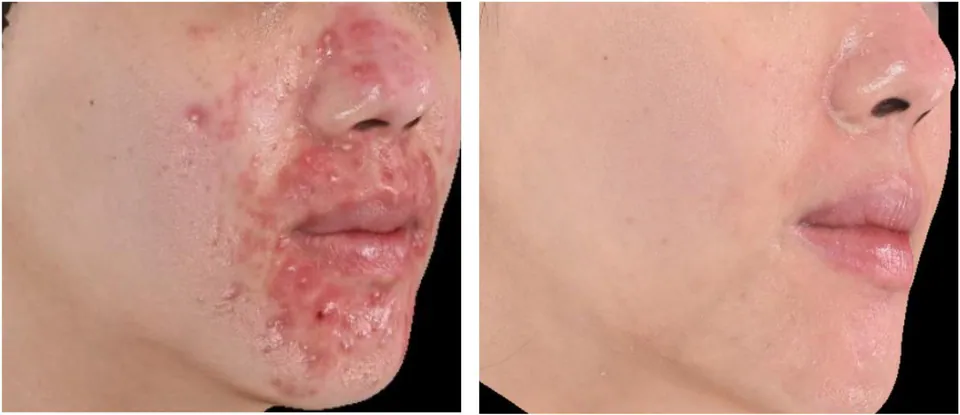 Acne before and after treatment at Dr Jinah Yoo Dermatology