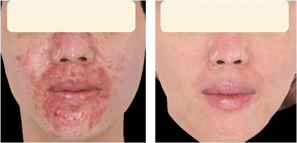 Acne before and after treatment at Dr Jinah Yoo Dermatology