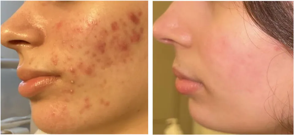 Acne before and after treatment at Dr Jinah Yoo Dermatology
