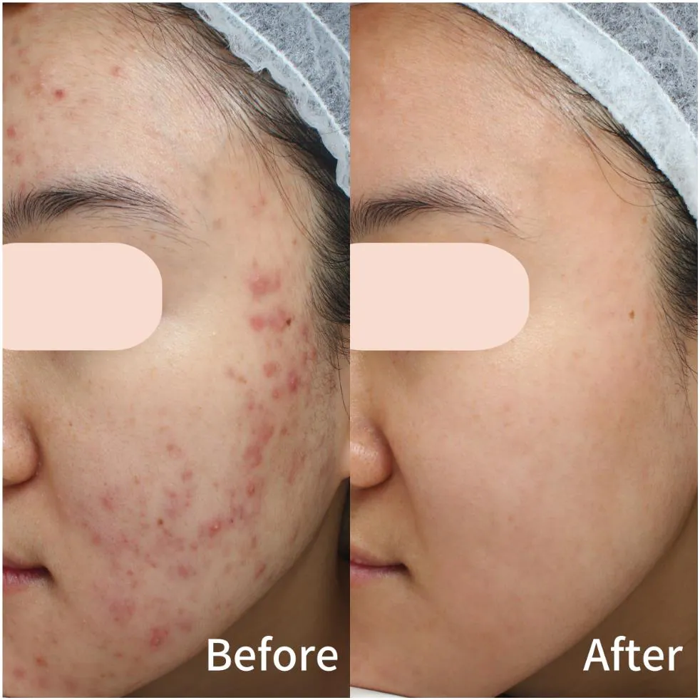 Acne before and after treatment at Dr Jinah Yoo Dermatology
