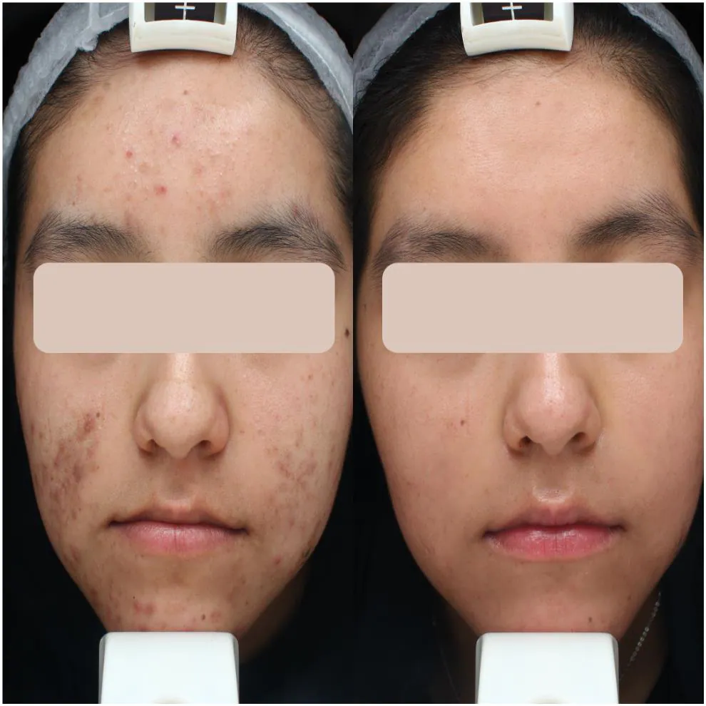 Acne scarring before and after treatment at Dr Jinah Yoo Dermatology
