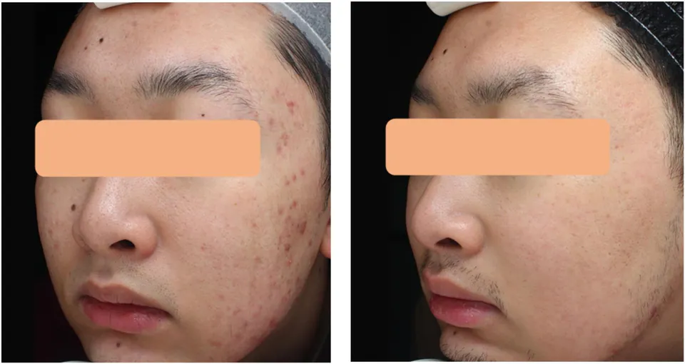 Acne scarring before and after treatment at Dr Jinah Yoo Dermatology