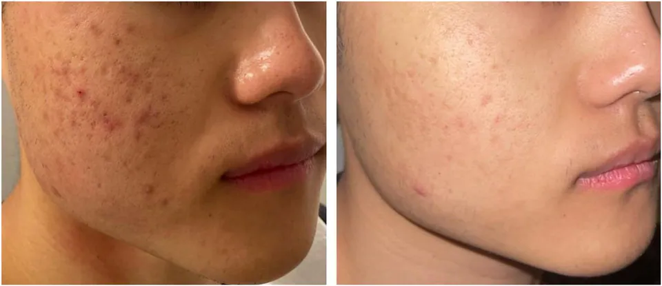 Acne scarring before and after treatment at Dr Jinah Yoo Dermatology