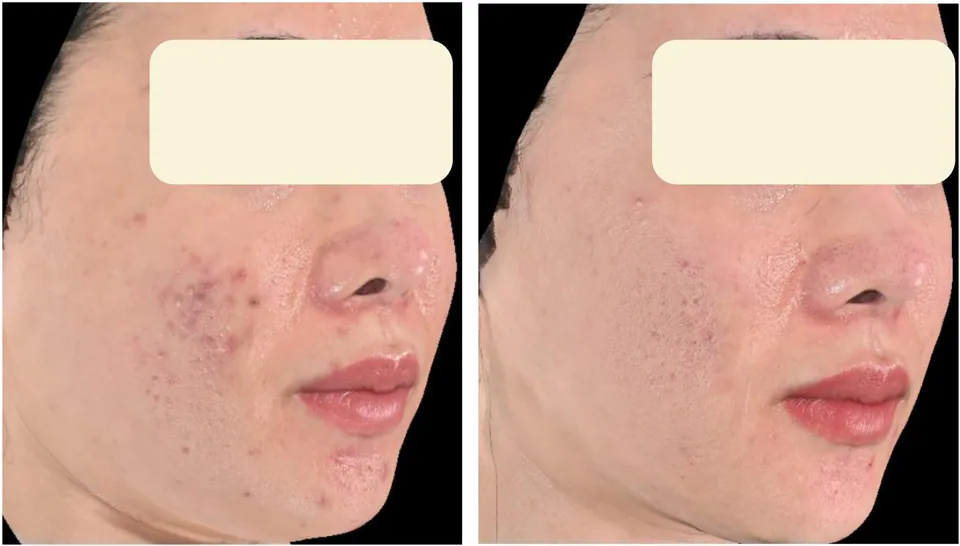 Acne scarring before and after treatment at Dr Jinah Yoo Dermatology