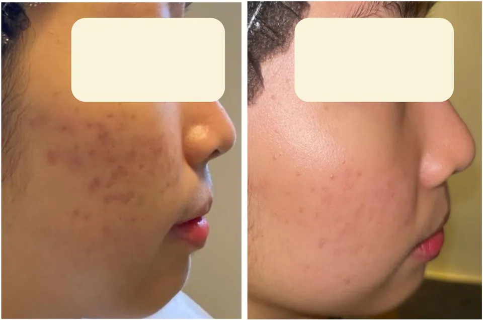Acne scarring before and after treatment at Dr Jinah Yoo Dermatology