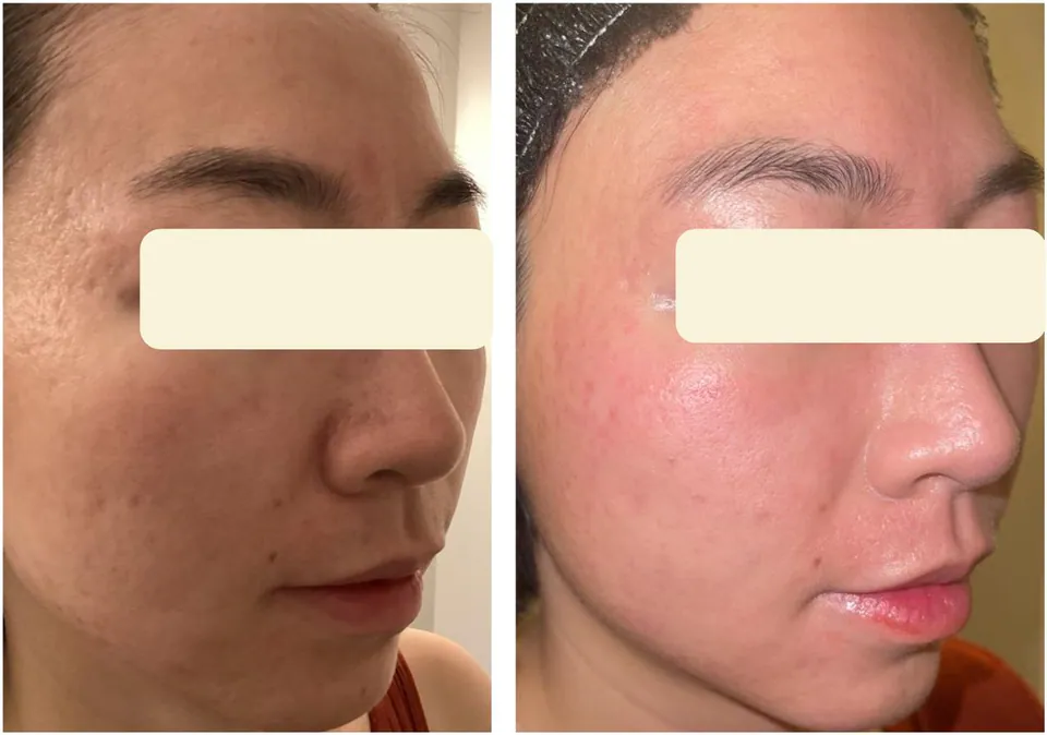 Acne scarring before and after treatment at Dr Jinah Yoo Dermatology