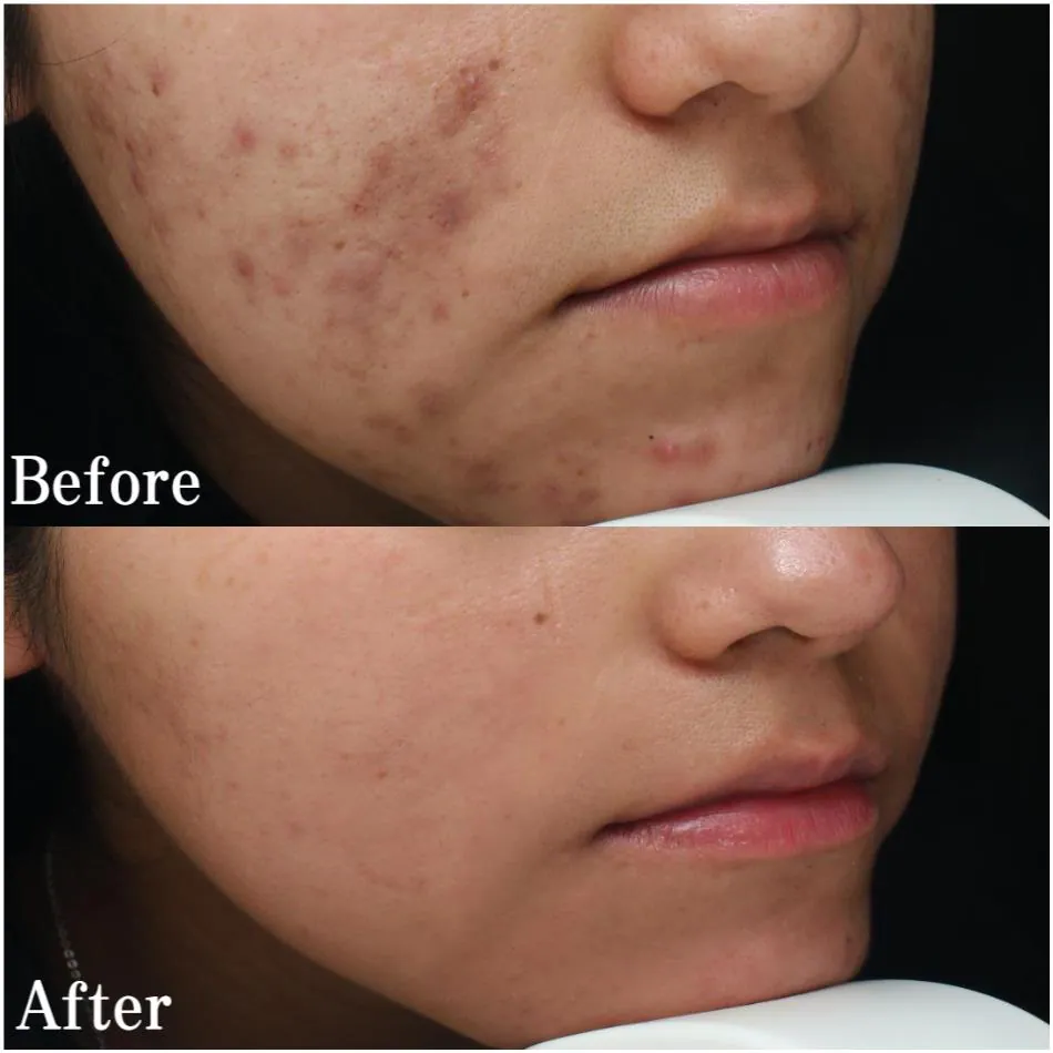 Acne scarring before and after treatment at Dr Jinah Yoo Dermatology