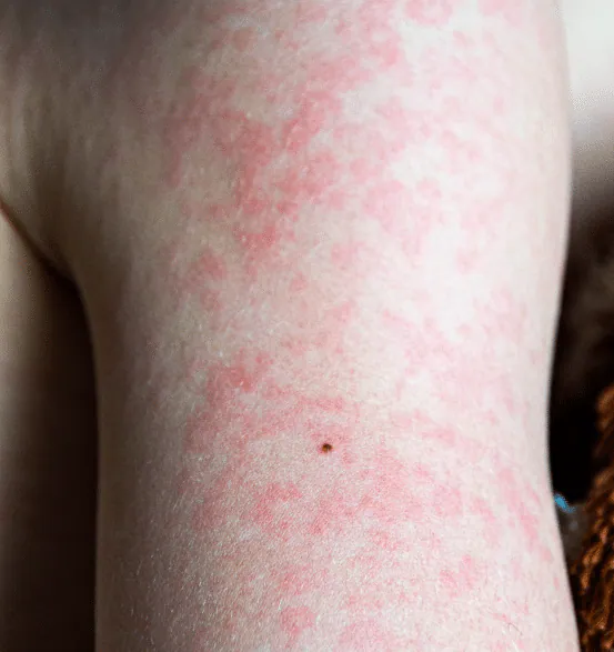 An arm covered in a widespread red, blotchy urticaria rash