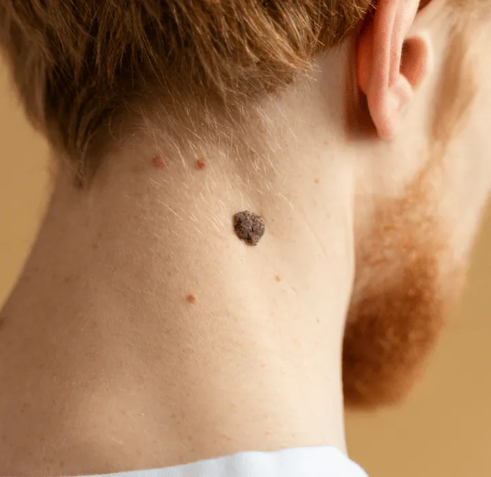 The back of a young man's neck with a single raised brown mole