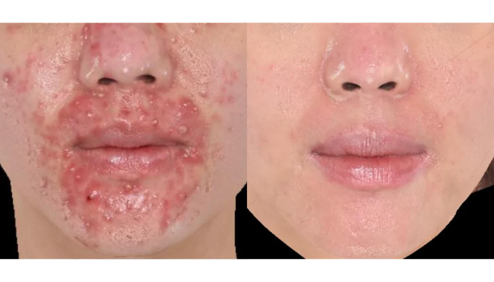 Before and after an acne programme, shown side by side