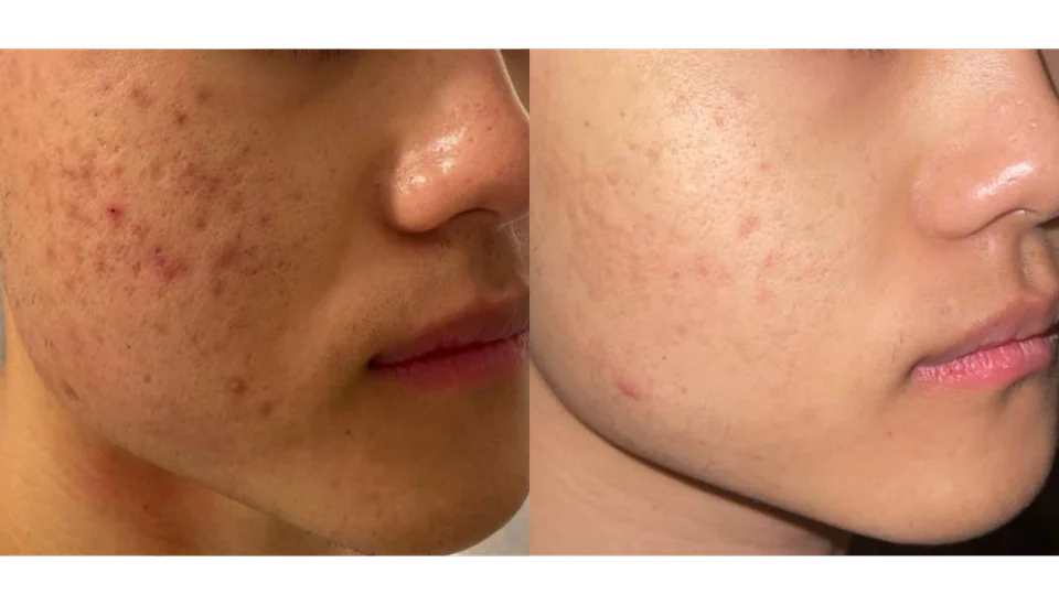 Before and after an acne scarring programme, shown side by side