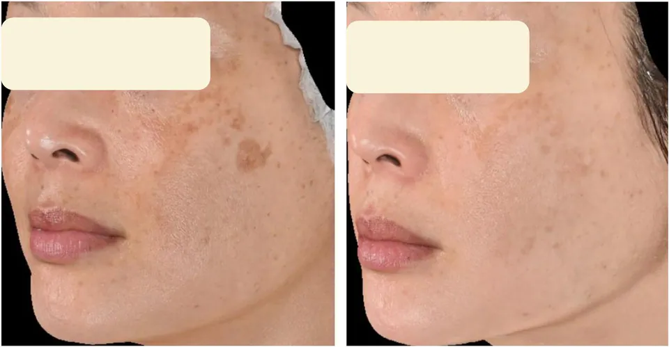Before and after: brightened cheek, even tone