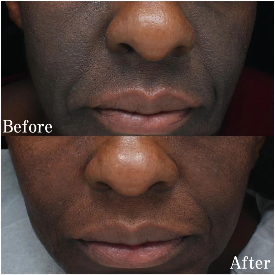 Before and after: brightened, even tone around the mouth