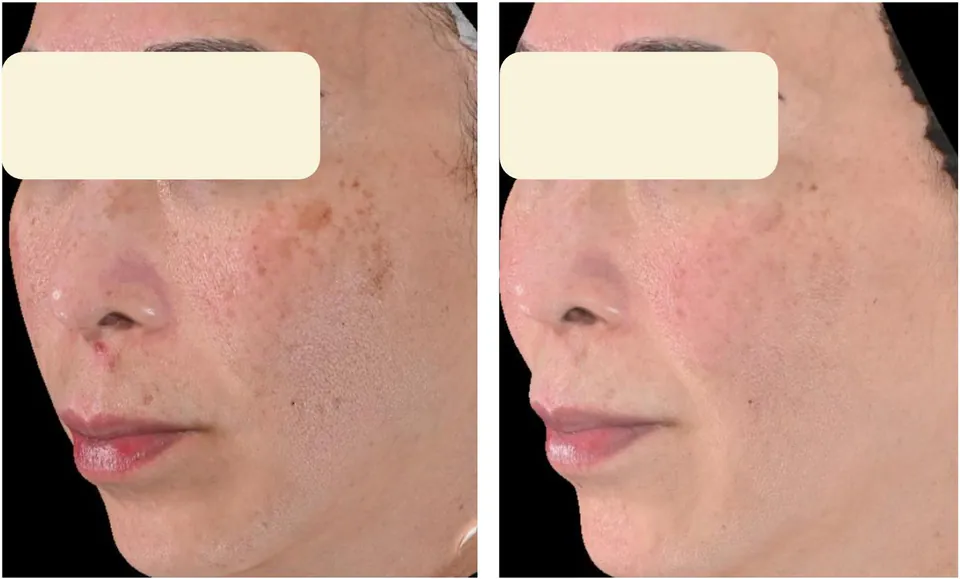 Before and after: cheek pigment cleared