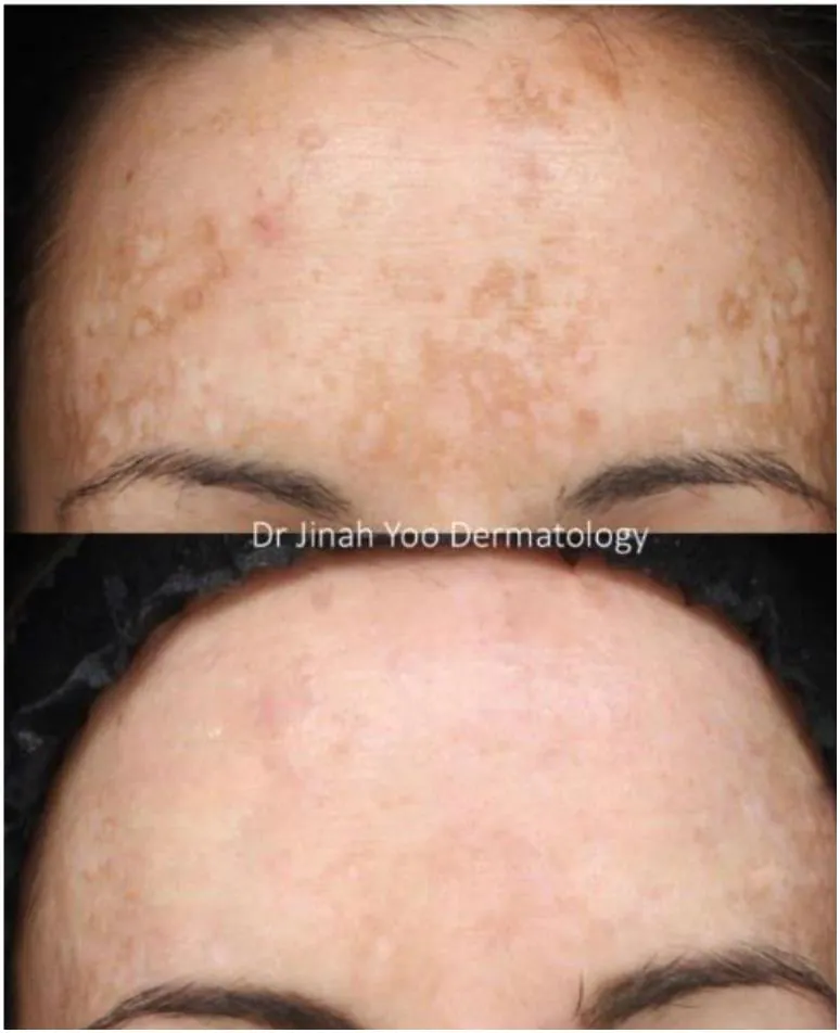 Before and after: cheek pigmentation cleared