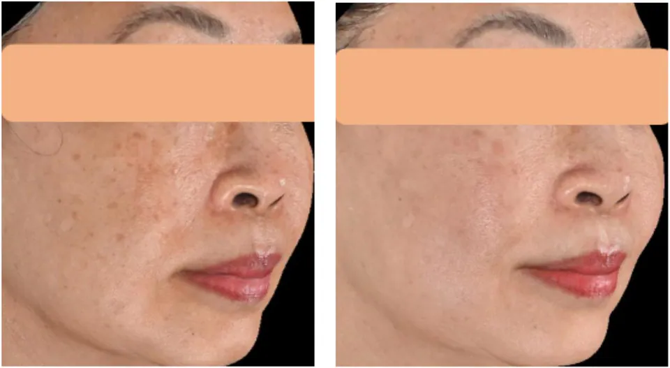 Before and after: clearer, brighter complexion