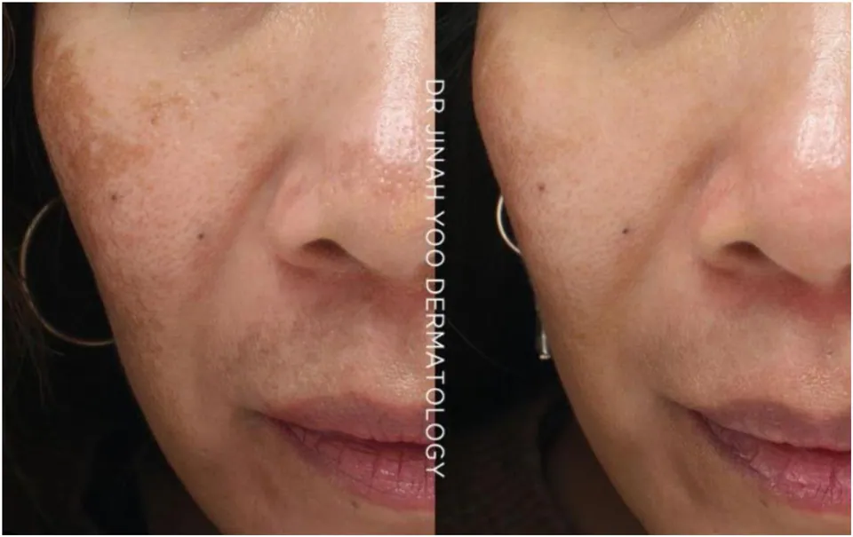 Before and after: dense melasma patch cleared