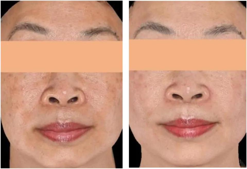 Before and after: even front-on tone