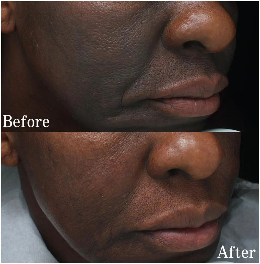 Before and after: even tone restored on deep skin tone