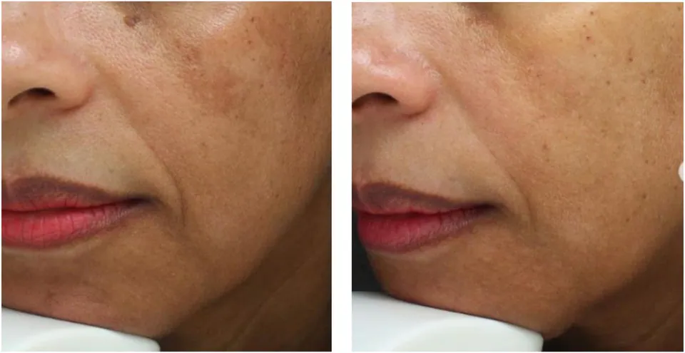 Before and after: even tone, softened patches