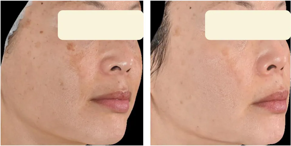 Before and after: forehead melasma cleared