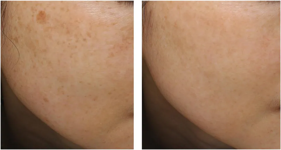 Before and after: freckling faded on the cheek