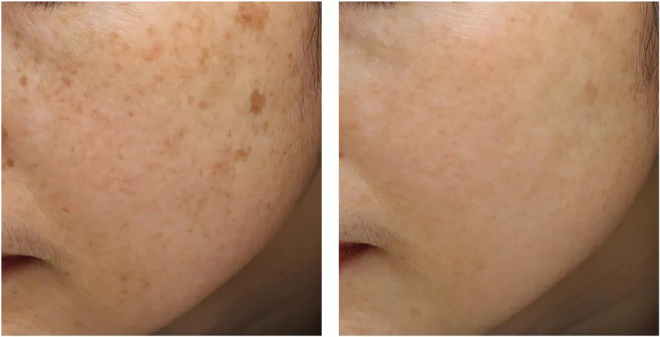 Before and after: lentigines cleared across the cheek