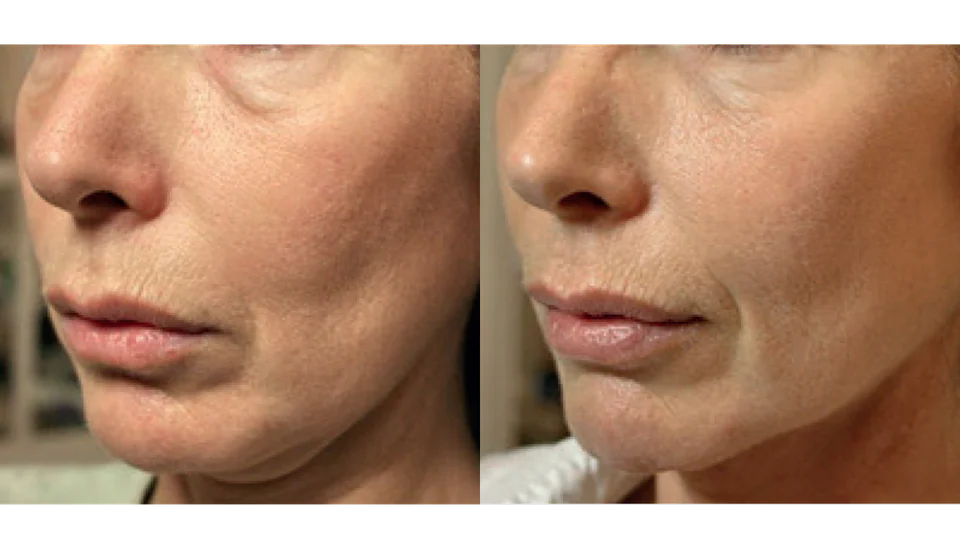 Before and after a lifting and tightening programme, shown side by side