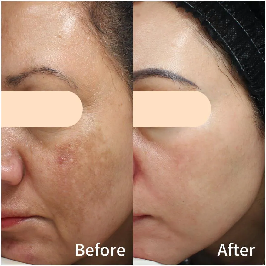 Before and after: melasma cleared across the cheek