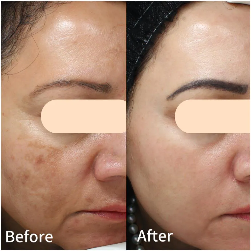 Before and after: pigmentation cleared, even tone