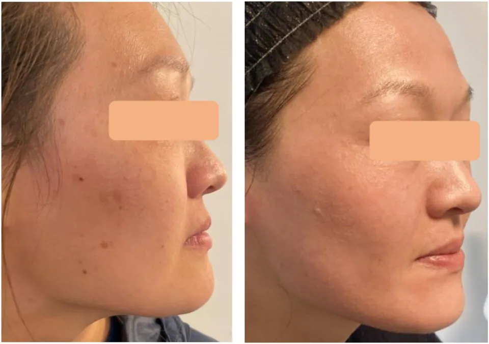 Before and after: pigmentation faded on profile view