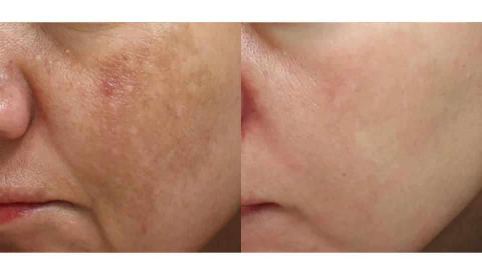 Before and after a pigmentation programme, shown side by side