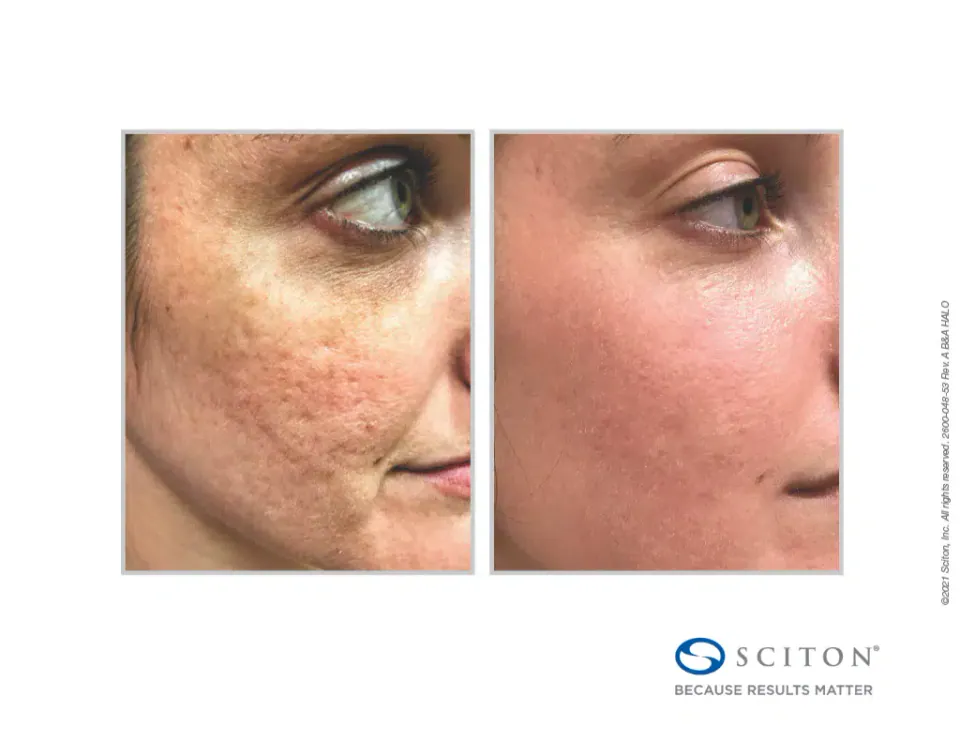 Cheek texture and pores before and after Halo treatment