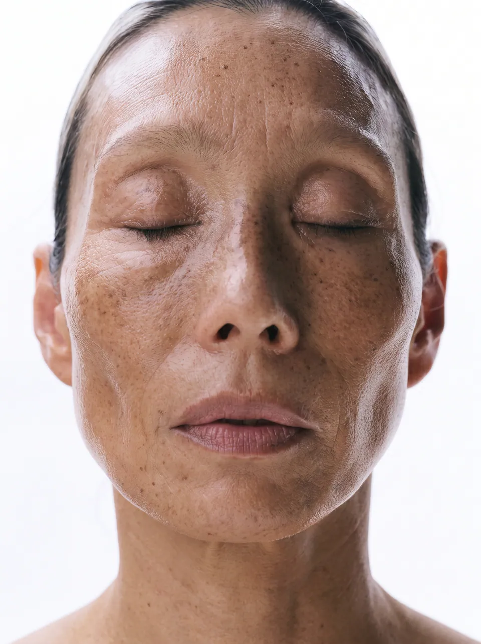 Close portrait of a woman with melasma across the cheeks and forehead