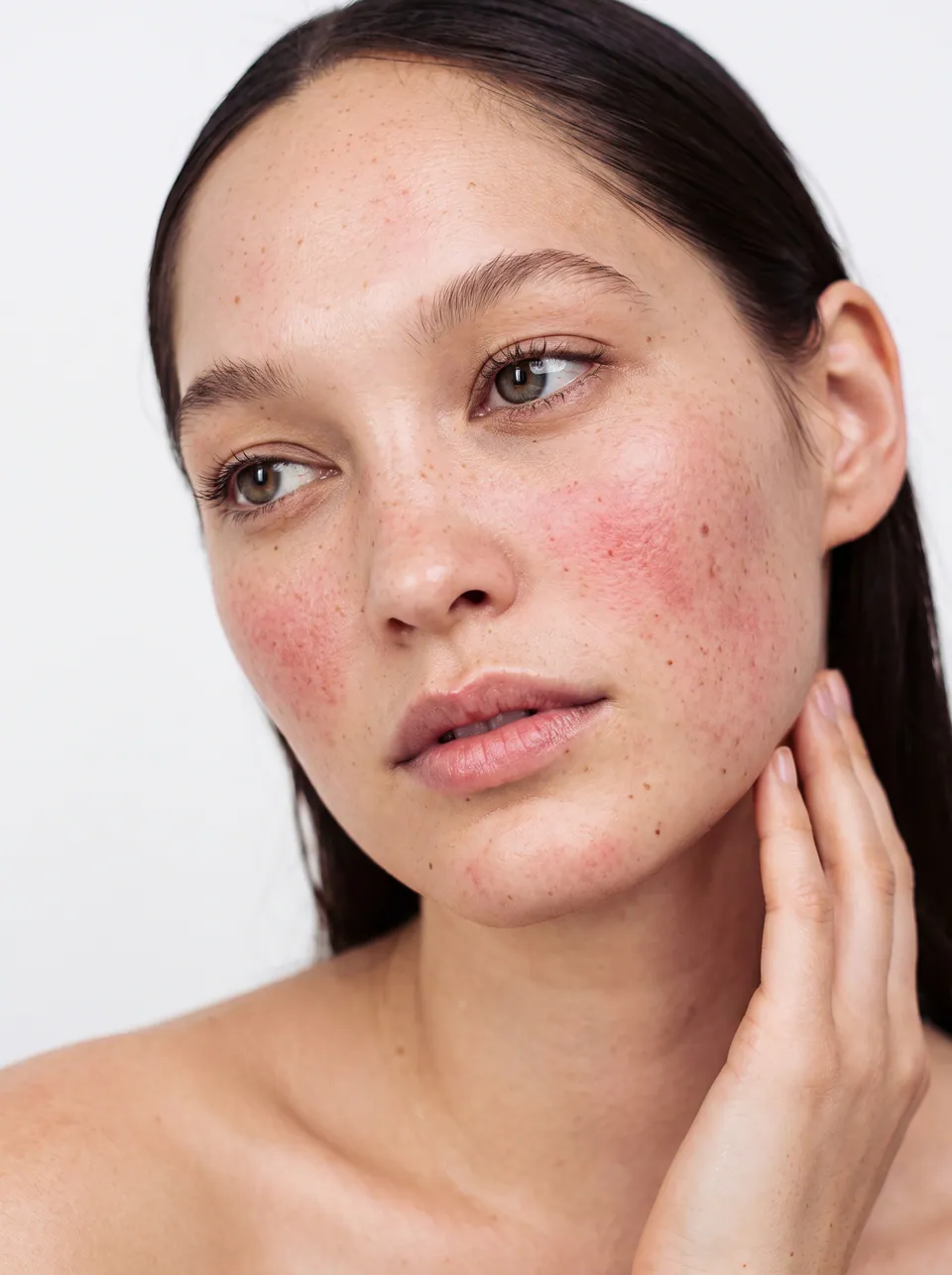 Close portrait of a woman with rosacea flushing across both cheeks