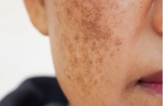 Close-up of a cheek with clustered brown sun-induced pigmentation