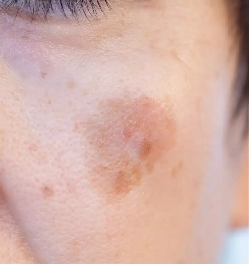 Close-up of a cheek with a larger, darker patch of age-spot pigmentation