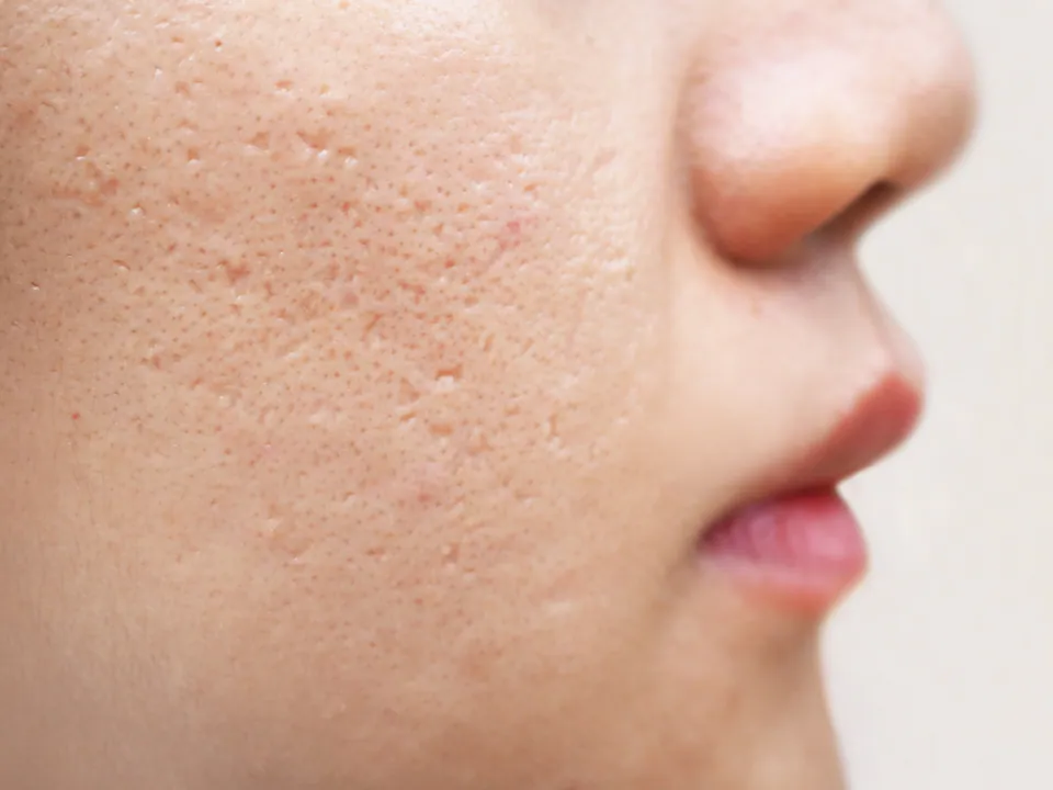 Close-up of a cheek with pitted acne scarring