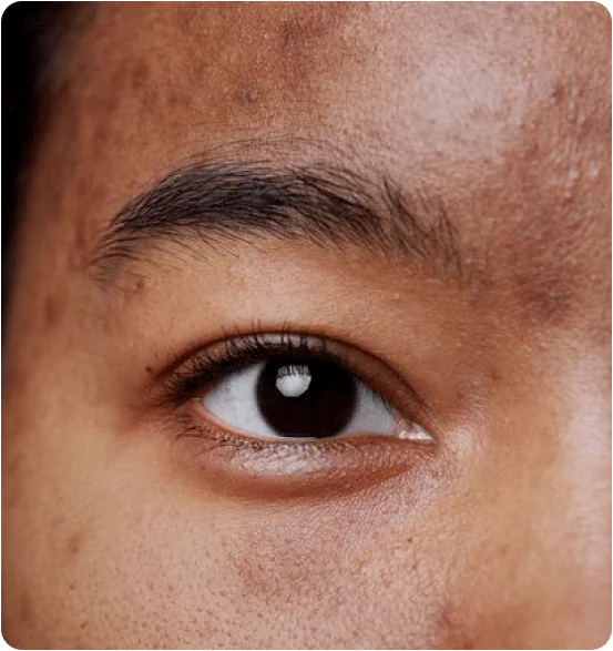 Close-up of an eye and brow with dark post-acne marks on the surrounding skin