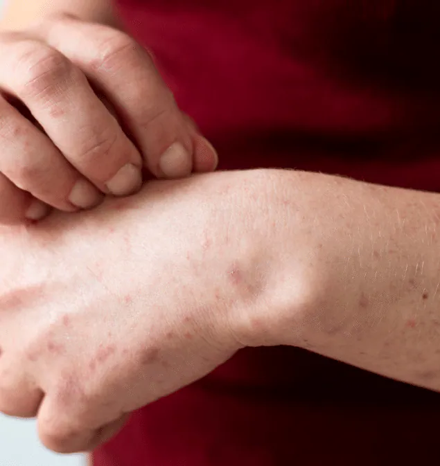 Close-up of hands scratching dry, red, irritated skin on the wrist