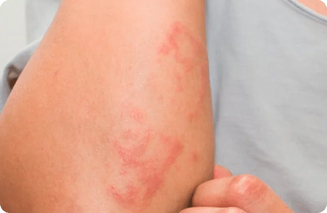 Close-up of red, raised hive welts on the upper arm
