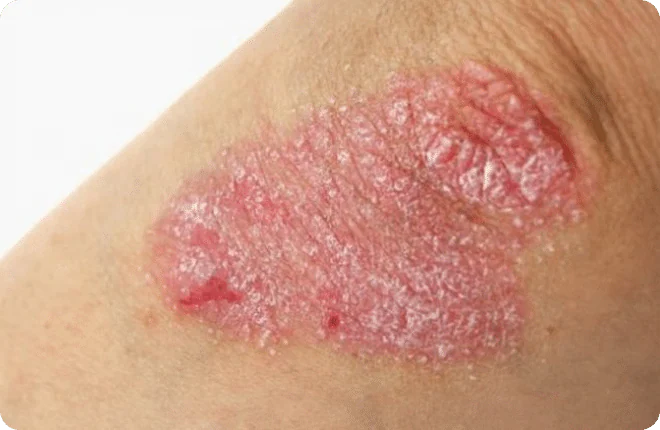 Close-up of a red, scaly psoriasis plaque on the elbow