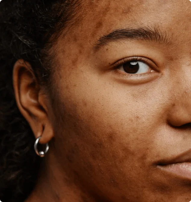 Close-up of a woman's cheek and jaw with uneven dark marks left after acne