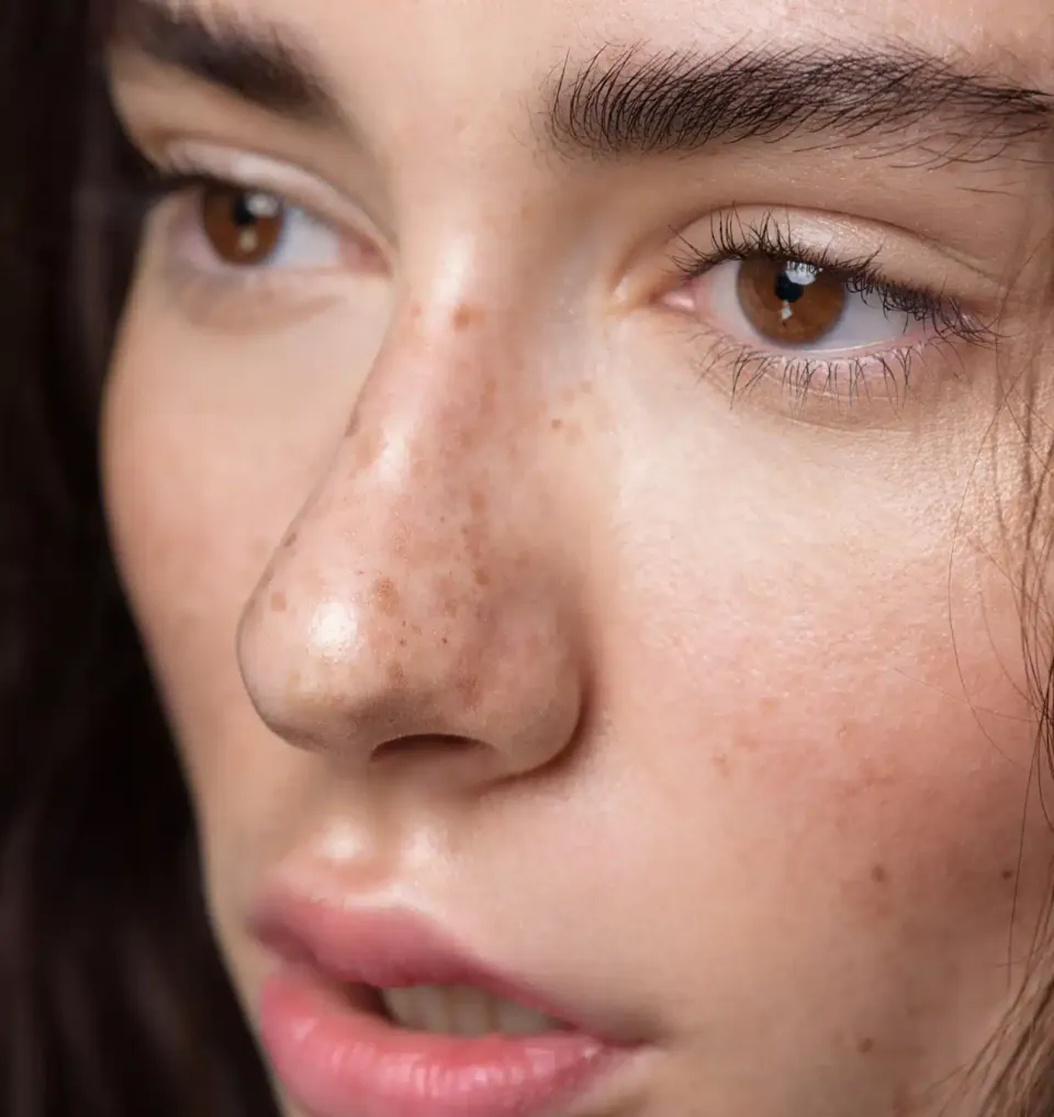 Close-up of a woman's face with fine freckles across the nose and cheeks