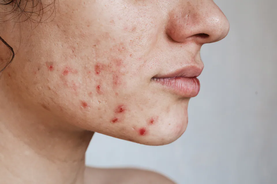 Close-up of a young woman's cheek and jaw with active acne